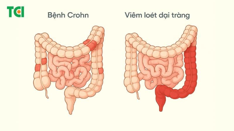 Các bệnh lý viêm ruột mạn tính làm tăng nguy cơ đau ruột thừa