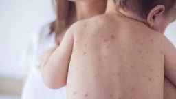 Bé bị thủy đậu kiêng gì: 5 nguyên tắc chính ba mẹ cần lưu ý