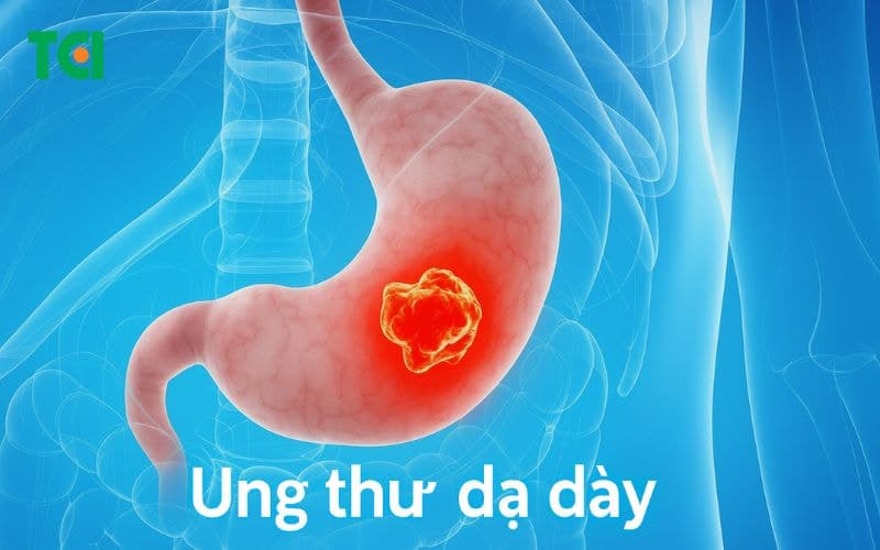 Căn cứ xác định các giai đoạn ung thư dạ dày