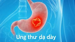 Các giai đoạn ung thư dạ dày và tiên lượng ở từng giai đoạn