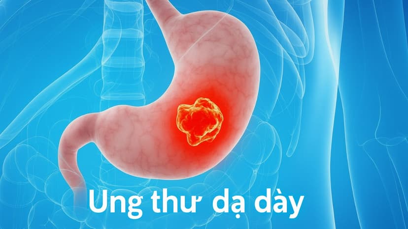 Các giai đoạn ung thư dạ dày và tiên lượng ở từng giai đoạn