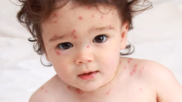 Cách điều trị bệnh thủy đậu hiệu quả và an toàn tối đa