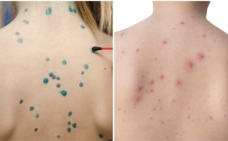 Điều trị bệnh thủy đậu: Tuân thủ theo phác đồ điều trị của bác sĩ