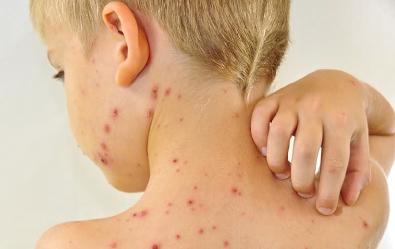 Điều trị bệnh thủy đậu: Dấu hiệu nhận biết ba mẹ cần lưu ý