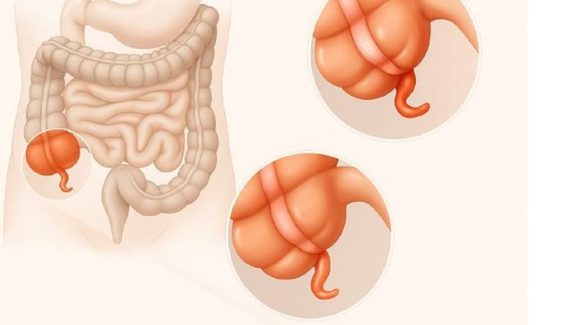 Cách nhận biết đau ruột thừa: Dấu hiệu và xử trí kịp thời