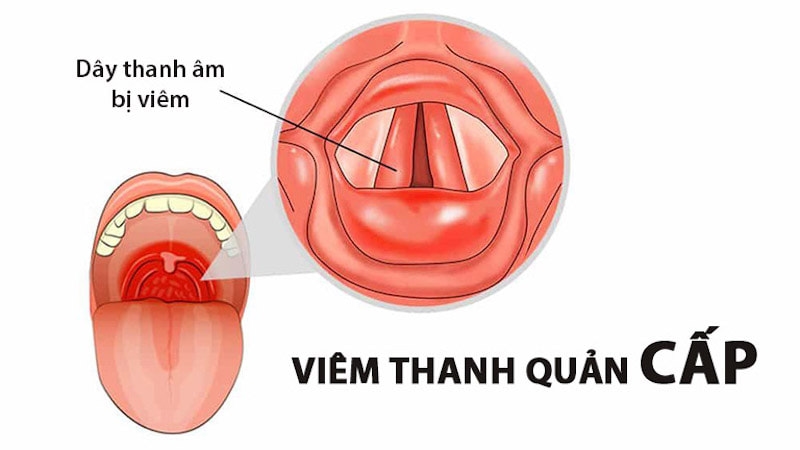 Phù nề thanh quản: Triệu chứng và nguyên nhân cần biết để điều trị kịp thời