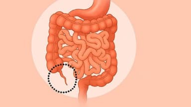 Cắt ruột thừa ảnh hưởng gì không – Tìm hiểu ngay để an tâm