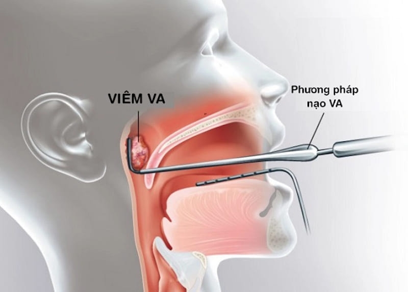 Có nên nạo VA cho trẻ: Kỹ thuật nạo VA chỉ được chỉ định trong một số trường hợp cụ thể