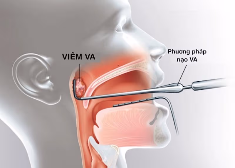 Có nên nạo VA cho trẻ: Kỹ thuật nạo VA chỉ được chỉ định trong một số trường hợp cụ thể