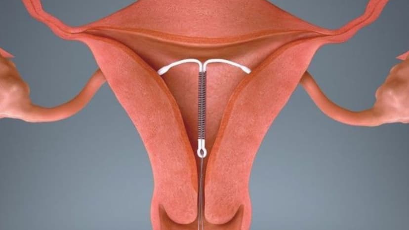 Đặt vòng tránh thai có bị chậm kinh không và dấu hiệu cần lưu ý