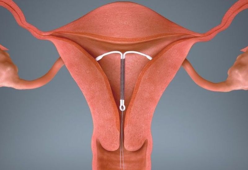 Đặt vòng tránh thai có bị chậm kinh không là thắc mắc chung của nhiều chị em phụ nữ sau khi lựa chọn biện pháp tránh thai này.