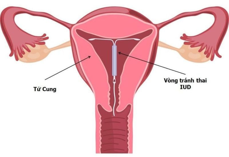 Đặt vòng tránh thai có tốt không? Phương pháp này khá phổ biến và an toàn hiện nay.