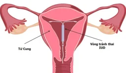 Đặt vòng tránh thai có tốt không? Ưu và nhược điểm cần biết