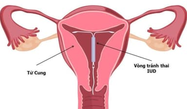 Đặt vòng tránh thai có tốt không? Ưu và nhược điểm cần biết