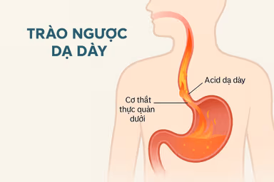 Đau họng do trào ngược dạ dày: Cần nhận biết để điều trị đúng