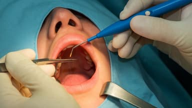 Đôi nét về phương pháp cắt amidan bằng dao điện truyền thống