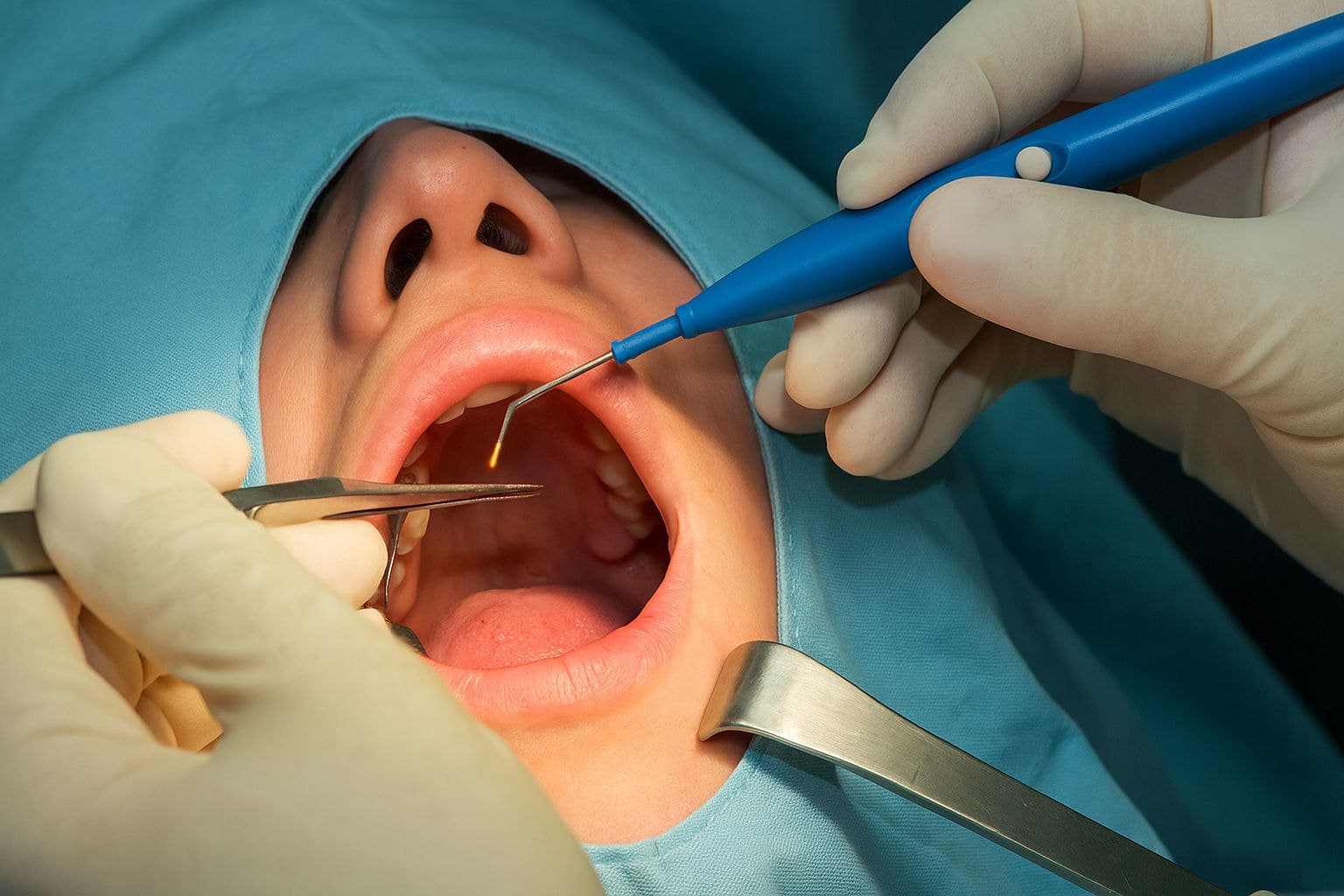 Cắt amidan bằng dao điện là phương pháp phẫu thuật sử dụng nhiệt năng từ dòng điện cao tần để bóc tách mô và cầm máu cùng lúc.