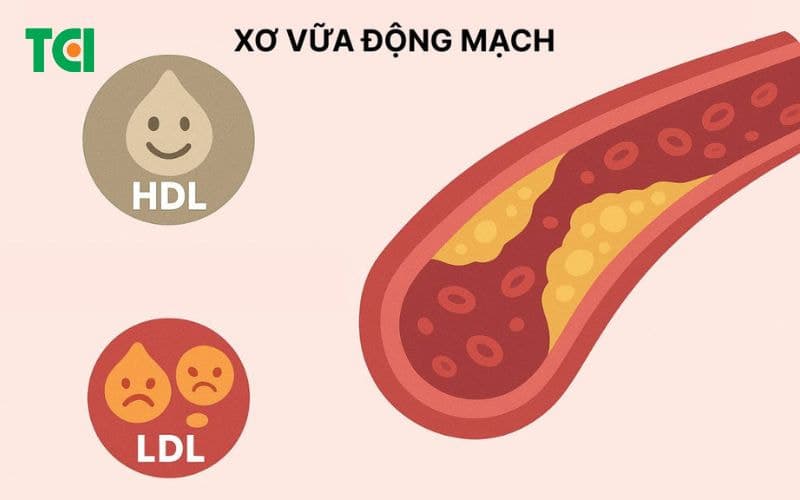 Nguyên nhân của xơ vữa động mạch phổ biến