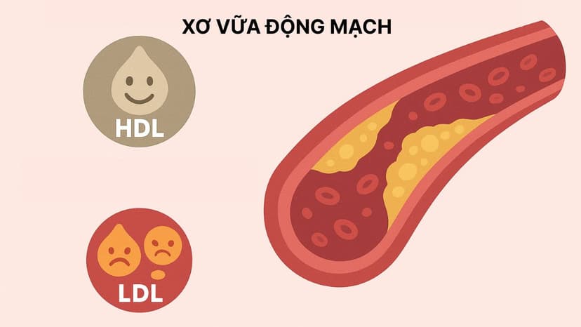 Hiểu đúng về nguyên nhân của xơ vữa động mạch