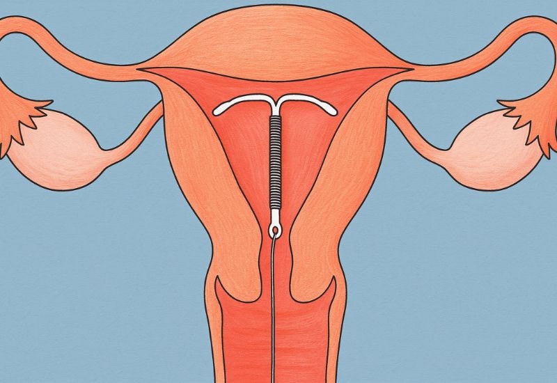 Đặt vòng tránh thai có gây tăng cân không là thắc mắc chung của nhiều chị em phụ nữ khi lựa chọn biện pháp tránh thai này.