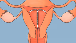 Hiểu đúng về việc đặt vòng tránh thai có gây tăng cân không