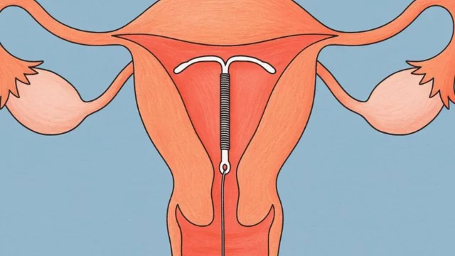 Hiểu đúng về việc đặt vòng tránh thai có gây tăng cân không