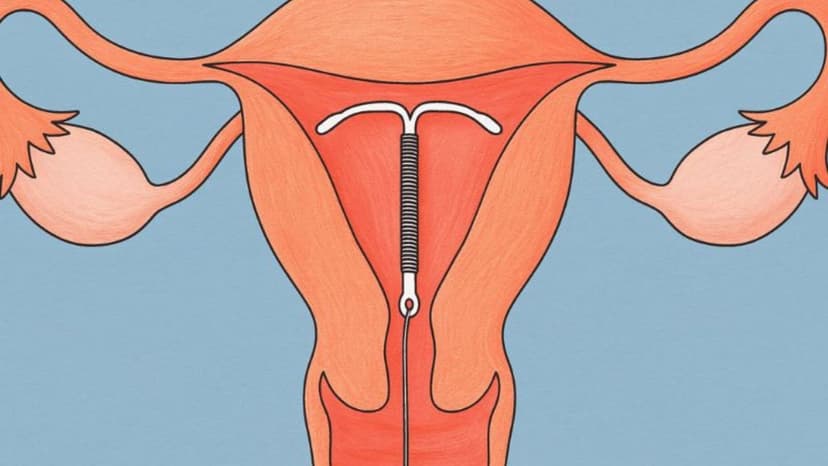 Hiểu đúng về việc đặt vòng tránh thai có gây tăng cân không