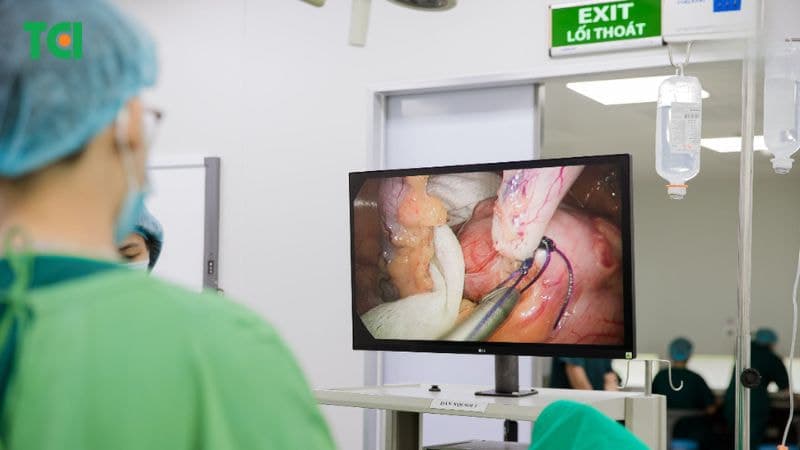 Phẫu thuật nội soi loại bỏ viêm ruột thừa