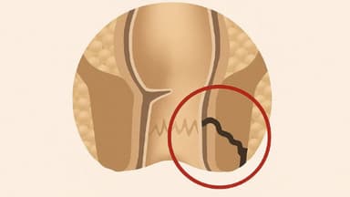 Nguyên nhân của bệnh rò hậu môn – Yếu tố không nên chủ quan