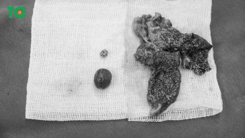 phẫu thuật cắt túi mật là lựa chọn an toàn và triệt để nhằm loại bỏ nguyên nhân gây bệnh