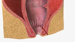 Nhận biết rò hậu môn: Dấu hiệu, biến chứng và điều trị
