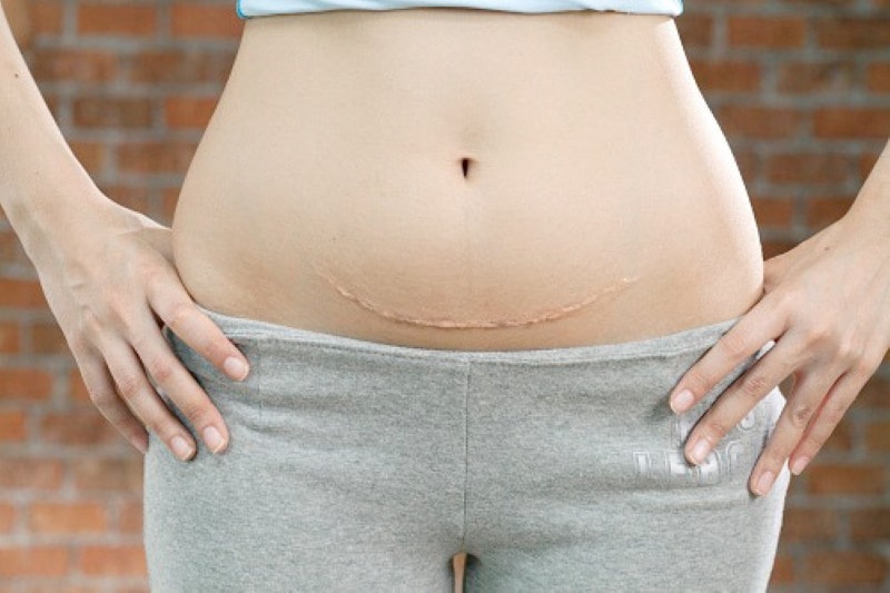 Lưu ý khi sinh mổ: Cần chú ý đảm bảo cung cấp đầy đủ chế độ dinh dưỡng cần thiết cho mẹ bầu sau sinh