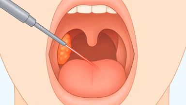 Những ưu nhược điểm của cắt amidan bằng laze