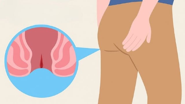 Nứt hậu môn là gì? Dấu hiệu nhận biết và điều trị đúng cách