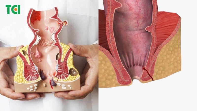 rò hậu môn có phải trĩ không