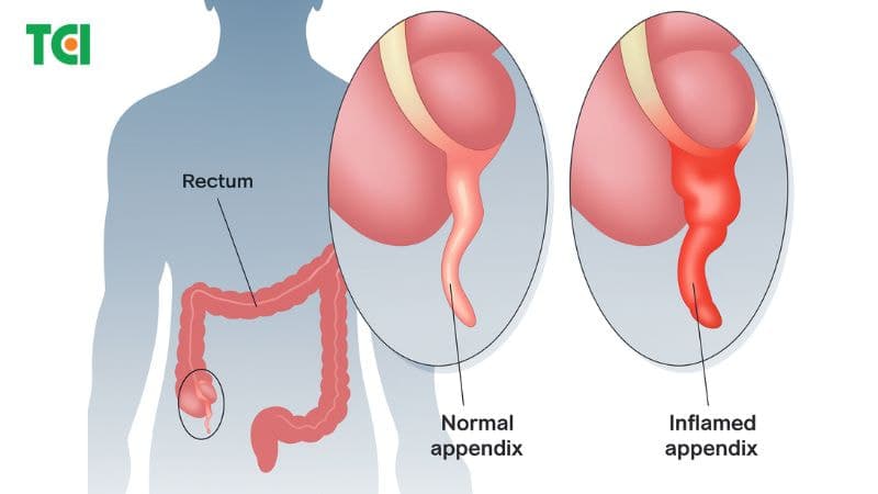 Hình ảnh ruột thừa bị viêm