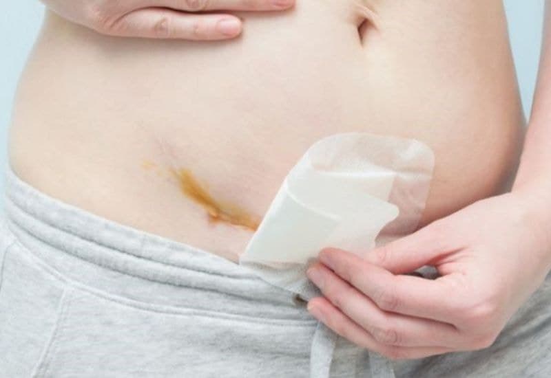 Sinh mổ ăn bún được không? Đây là băn khoăn của nhiều mẹ bầu