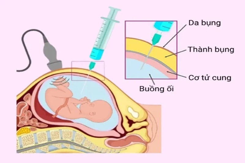 Xét nghiệm sàng lọc trước sinh
