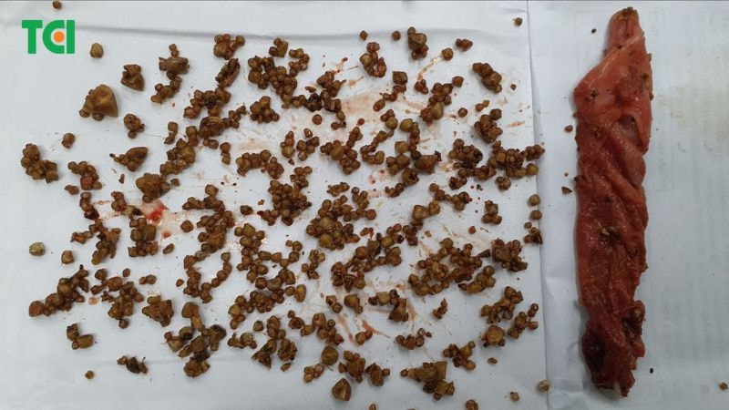 HÌnh ảnh một túi mật bị viêm hoại tử do 800 viên sỏi được xử lý tại TCI