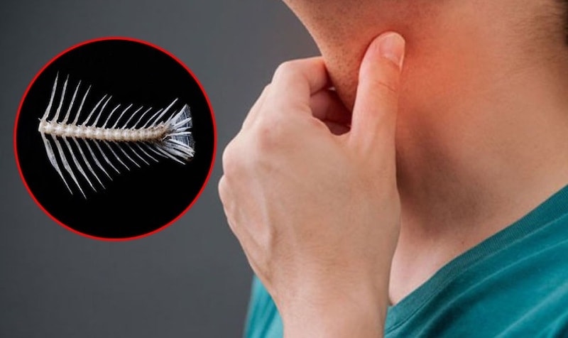 Cách chữa hóc xương ở cổ họng: Không nên áp dụng những cách khiến hóc xương trở nên nặng hơn
