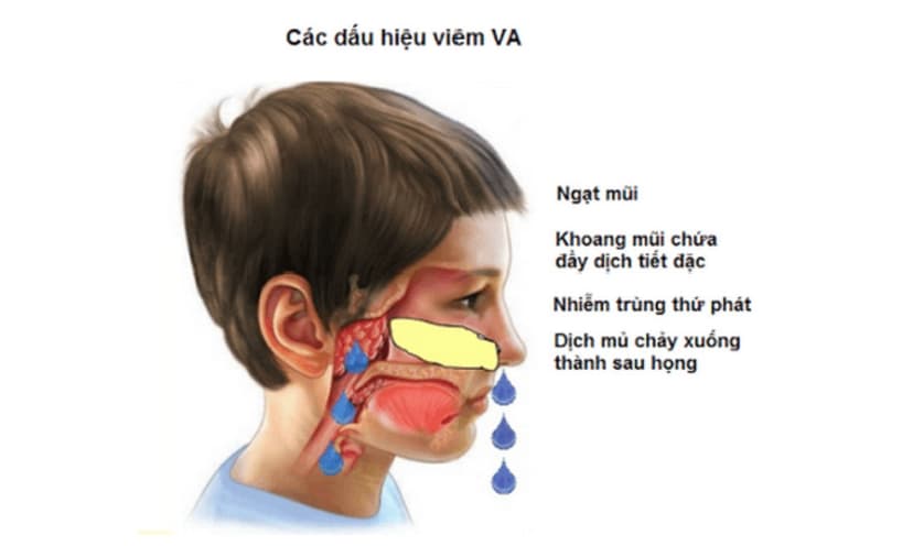 Trẻ mấy tuổi thì nạo VA: Những điều ba mẹ cần lưu ý