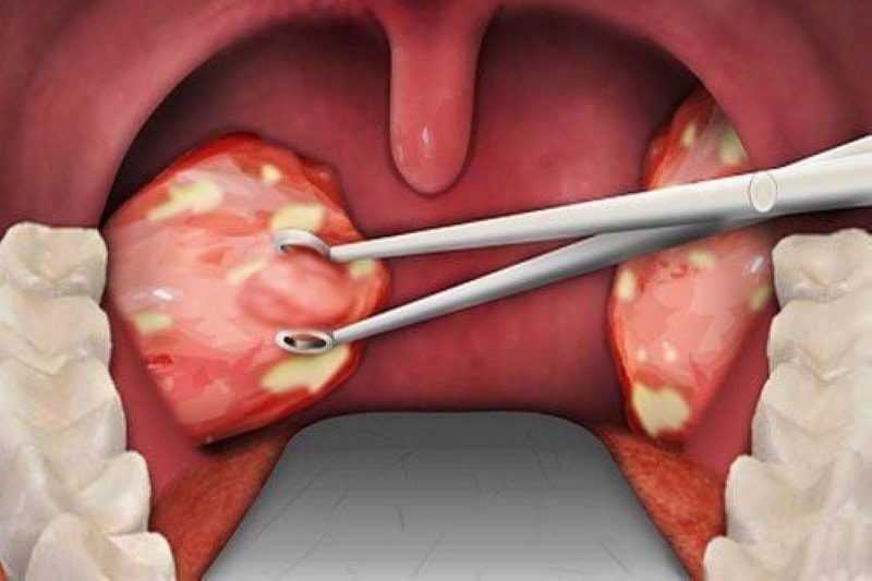 Trẻ mấy tuổi thì nạo VA: Cho trẻ cắt theo chỉ định của bác sĩ