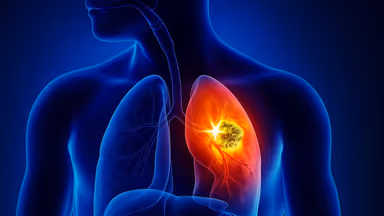 Triệu chứng u phổi: Nhận biết sớm để bảo vệ lá phổi khỏe mạnh