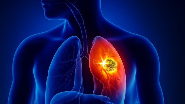 Triệu chứng u phổi: Nhận biết sớm để bảo vệ lá phổi khỏe mạnh