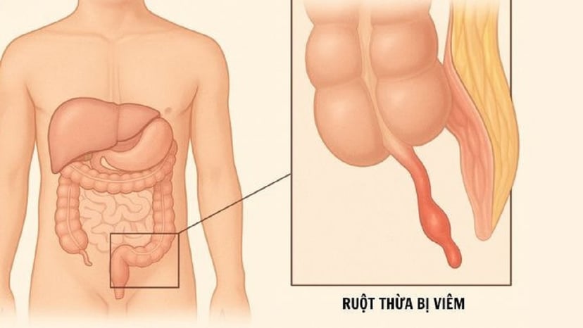 Viêm ruột thừa: Bệnh lý cấp cứu nguy hiểm cần xử trí sớm