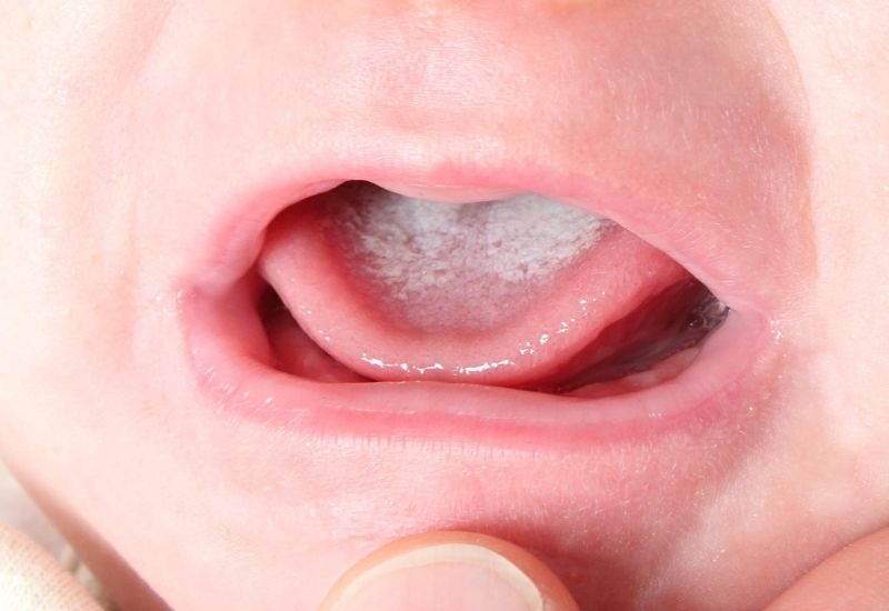 Dấu hiệu nhận biết: Cách phân biệt bé bị nấm miệng với cặn sữa
