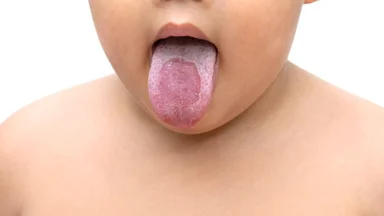 Bé bị nấm miệng: Hướng dẫn điều trị hiệu quả