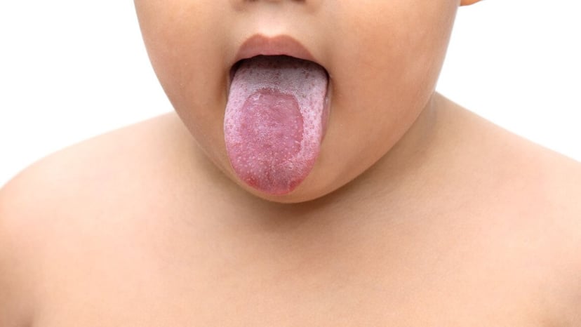 Bé bị nấm miệng: Hướng dẫn điều trị hiệu quả