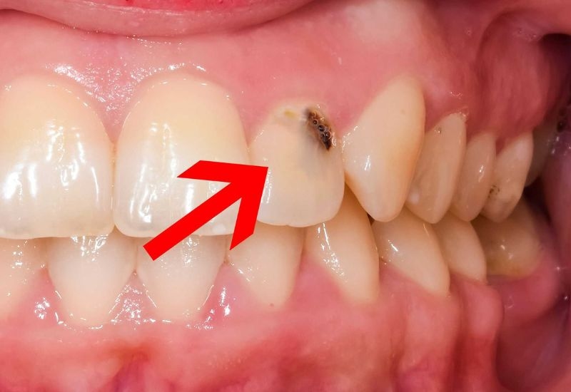 răng cửa bị sâu