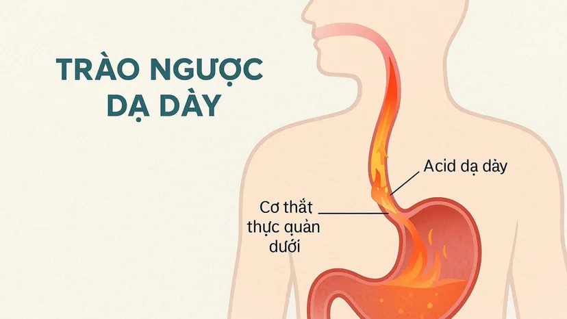 Cách ăn uống cho người bị trào ngược dạ dày hỗ trợ điều trị
